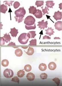 Slika 15. Izmenjen eritrociti. A.Akantociti; B. ‘’Duhovi’’, samo obrisi eritrocita (imunoposredovana vaskularna liza eritrocita) C. Šistociti D. Normalni eritrociti