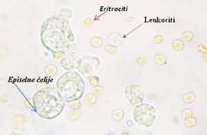 Slika 7. Eritrociti, leukociti i epitelne ćelije