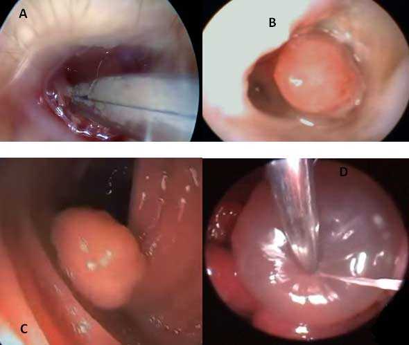 Polypectomy – Endoscopic removal of polyps - IVAVET